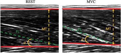 Characterization of the vastus lateralis torque-length, and knee extensors torque-velocity and power-velocity relationships in people with Parkinson's disease